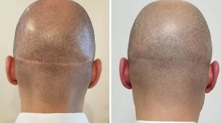 زراعة الشعر مكان الخياطة