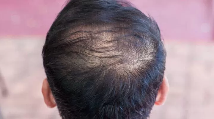 شروط زراعة الشعر