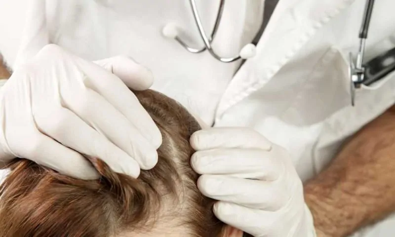 عملية زرع الشعر | معلومات قد تسمعها لأول مرة 11 كم تستغرق عملية زرع الشعر