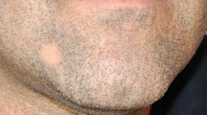زراعة شعر ذقن