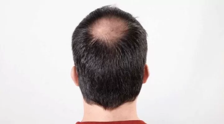 عيوب زراعة الشعر