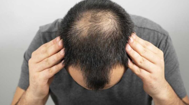 مخاطر زراعة الشعر