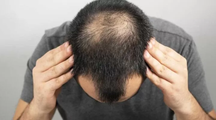 مخاطر زراعة الشعر