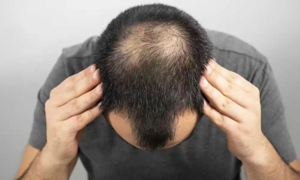 مخاطر زراعة الشعر