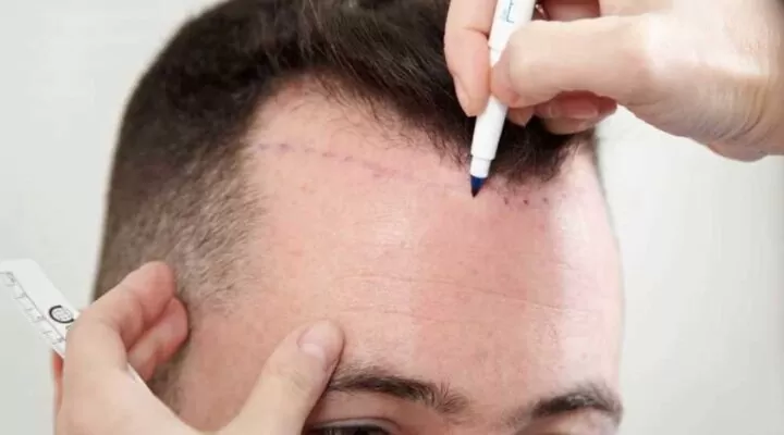 مركز زراعة الشعر