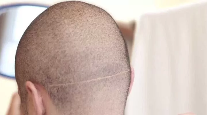 زراعة الشعر في الندبات