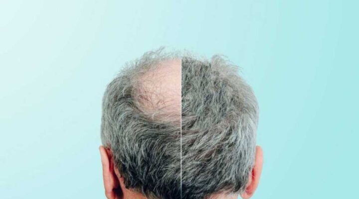 أنواع زراعة الشعر