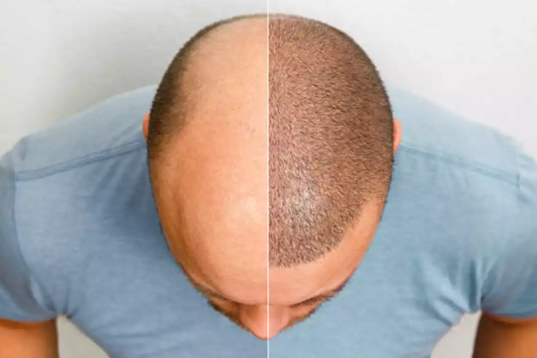 ما هو العمر المناسب لزراعة الشعر للرجال والسيدات 2 التقنيات المستخدمة في زراعة الشعر