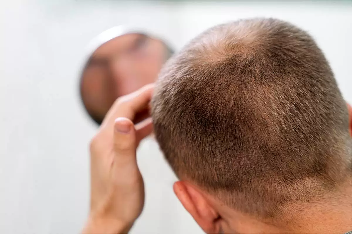 ما هو العمر المناسب لزراعة الشعر للرجال والسيدات 3 أهمية معرفة العمر المناسب لزراعة الشعر
