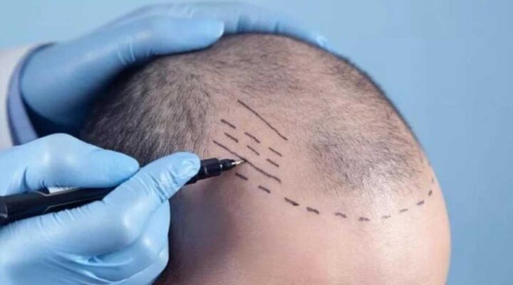 تقنيات زراعة الشعر