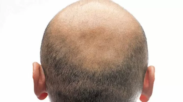 زراعة الشعر الدرجة السابعة