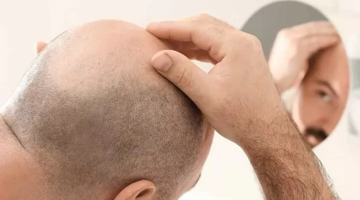زراعة الشعر الصلع الكامل