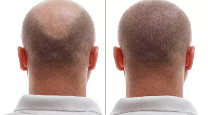 نتائج زراعة الشعر بالصور