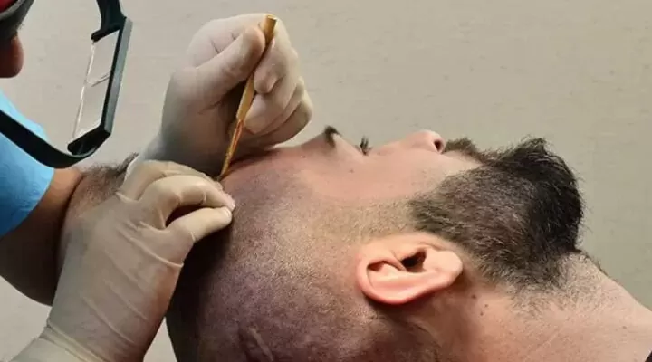 اسعار زراعة الشعر