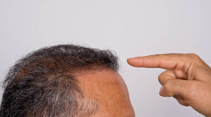 زراعة الشعر الإيطالي