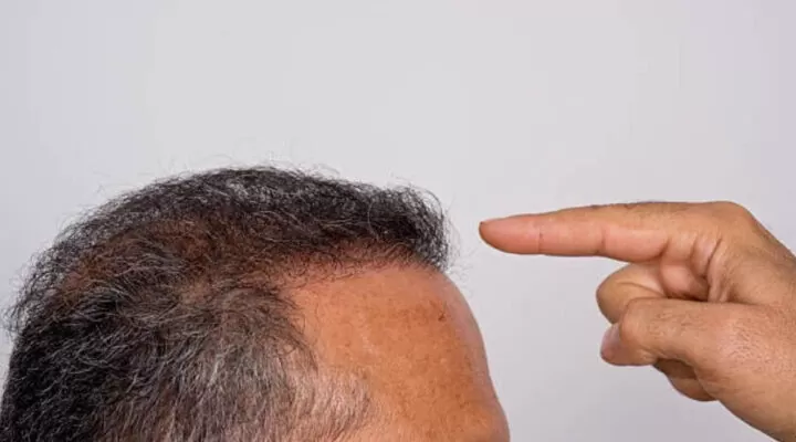 زراعة الشعر الإيطالي