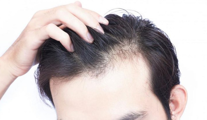زراعة الشعر لمرضى الثعلبة