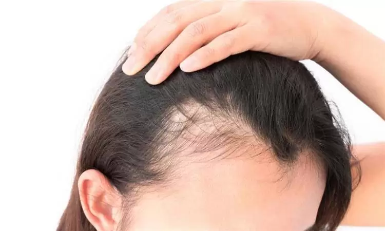 علاج الشعر المتساقط عند البنات