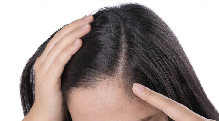 علاج تساقط الشعر
