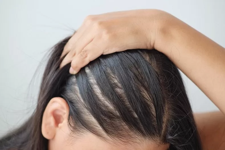 علاج فراغات الشعر  عند النساء