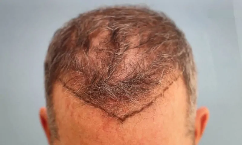 عملية زرع الشعر | معلومات قد تسمعها لأول مرة 2 تقنيات عملية زرع الشعر الطبيعي