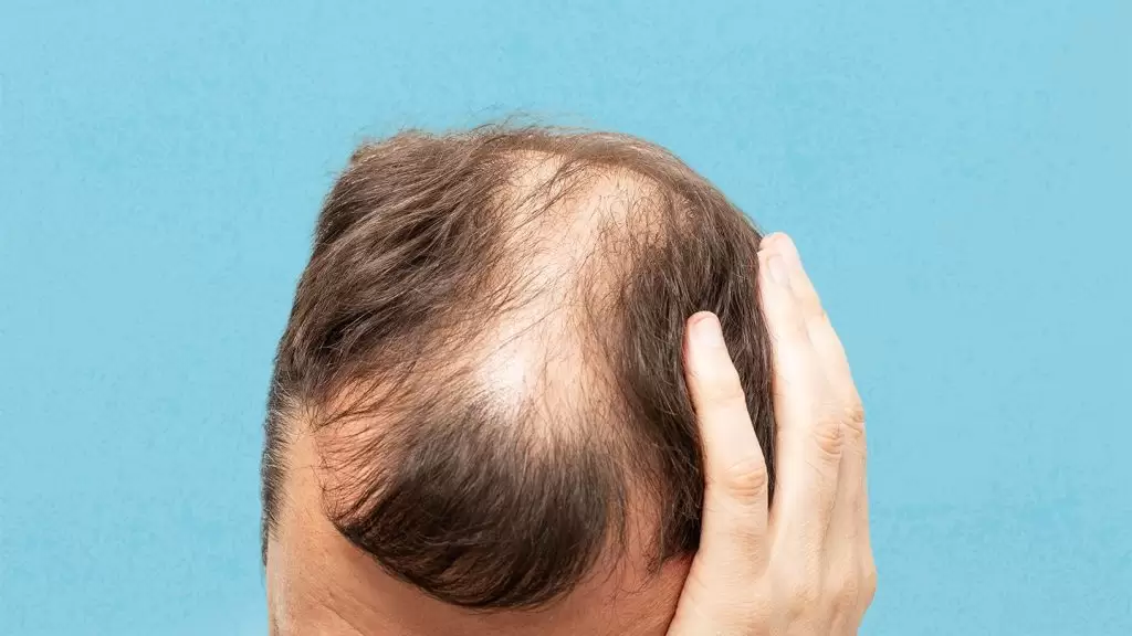 عملية زرع الشعر | معلومات قد تسمعها لأول مرة 13 نصائح قبل إجراء عملية زرع الشعر