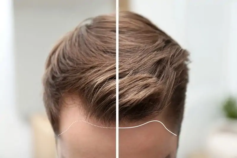 عملية زرع الشعر | معلومات قد تسمعها لأول مرة 3 عملية زرع الشعر بأقلام تشوي