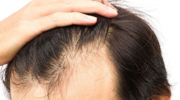 عملية زراعة الشعر
