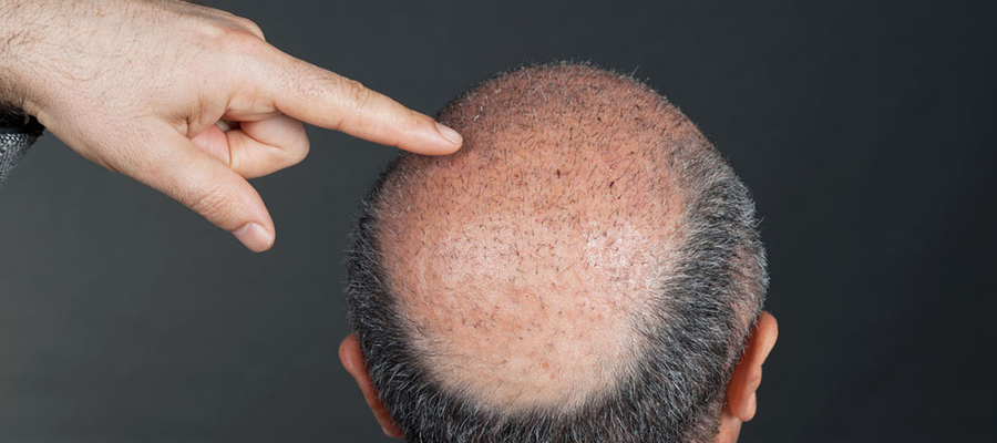 خطوات عملية زراعة الشعر
