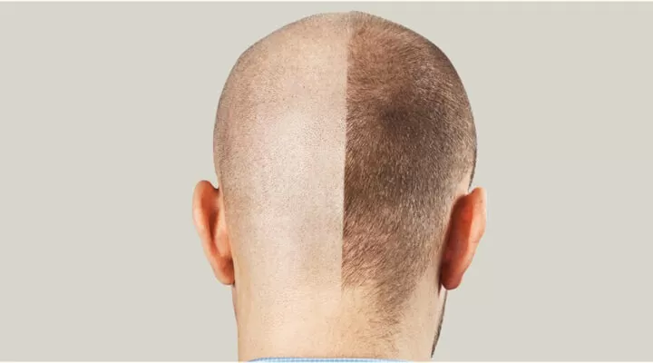 اهم مراحل زراعة الشعر زمنيا