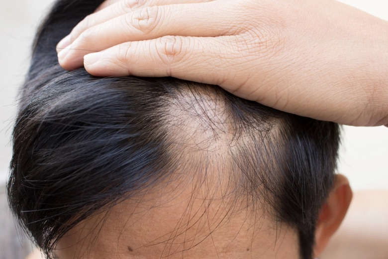 زراعة الشعر لمرضى الثعلبة 2025 3 ما هو مدى خطورة مرض الثعلبة