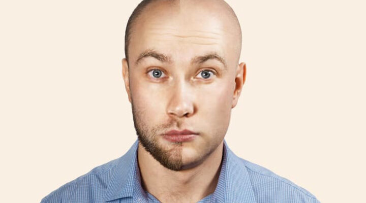 هل يمكن زراعة الشعر من شخص اخر