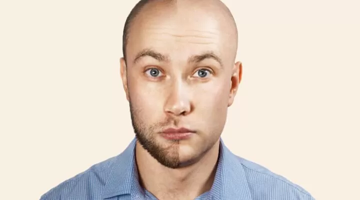 هل يمكن زراعة الشعر من شخص اخر