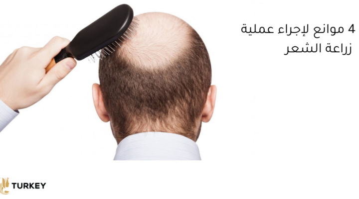 4 موانع لإجراء عملية زرع الشعر