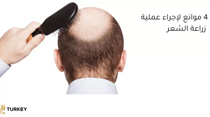 4 موانع لإجراء عملية زرع الشعر