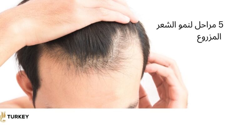 مراحل نمو الشعر بعد الزراعة