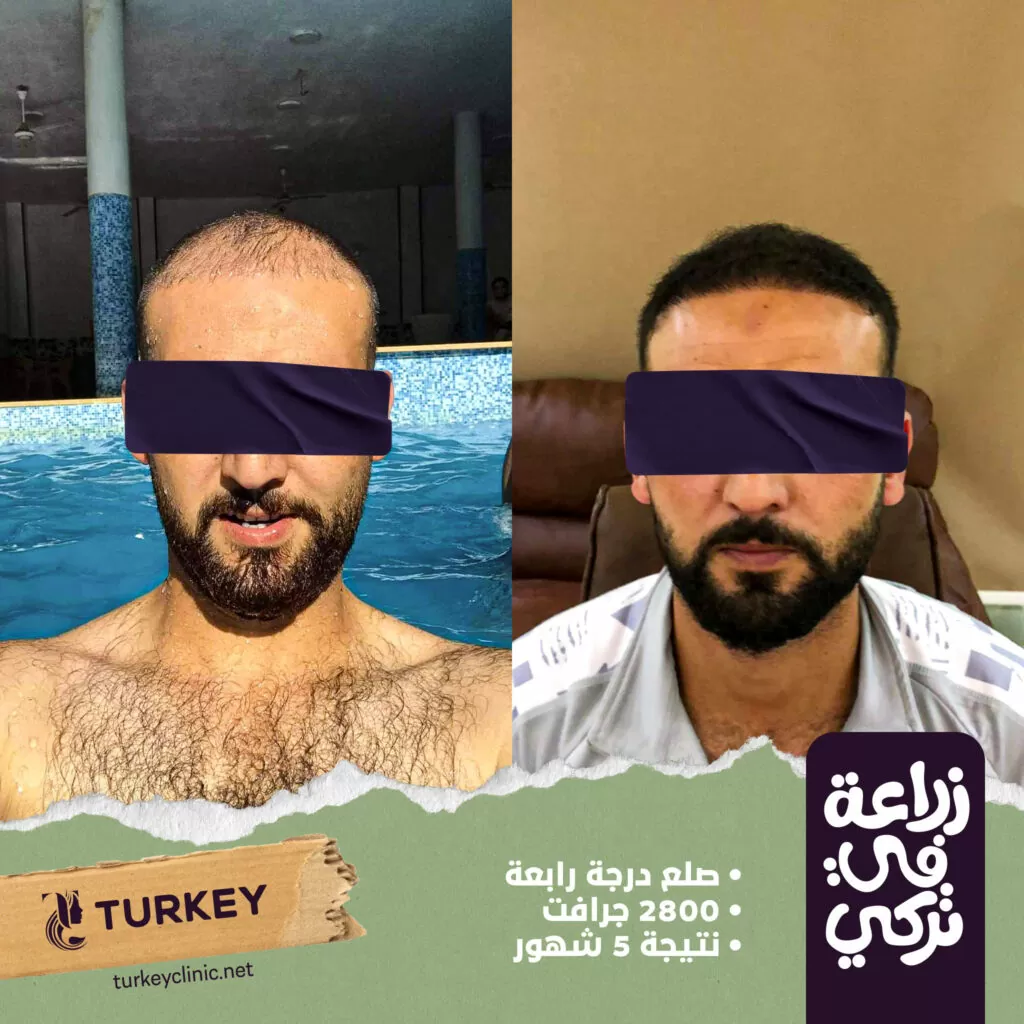 صور عمليات زراعة الشعر قبل وبعد