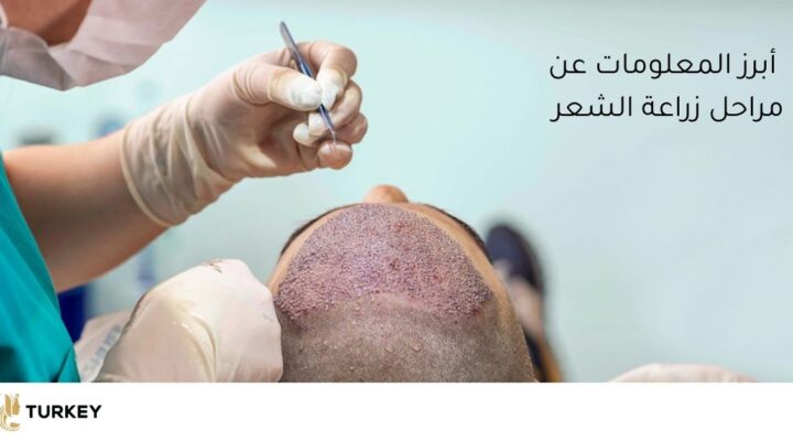مراحل زراعة الشعر بالصور