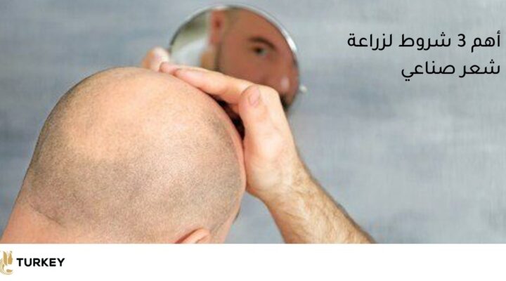 أهم 3 شروط لزرع الشعر الإيطالي