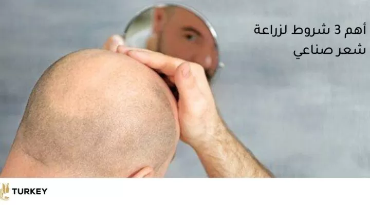 أهم 3 شروط لزرع الشعر الإيطالي