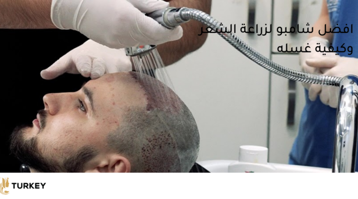 افضل شامبو بعد زراعة الشعر وكيفية استعماله