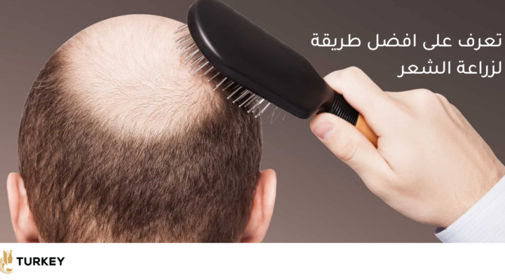 افضل طرق زرع الشعر