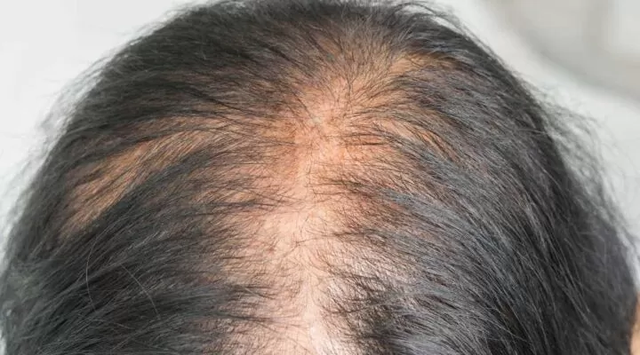 الحل النهائي لتساقط الشعر وتكثيفه