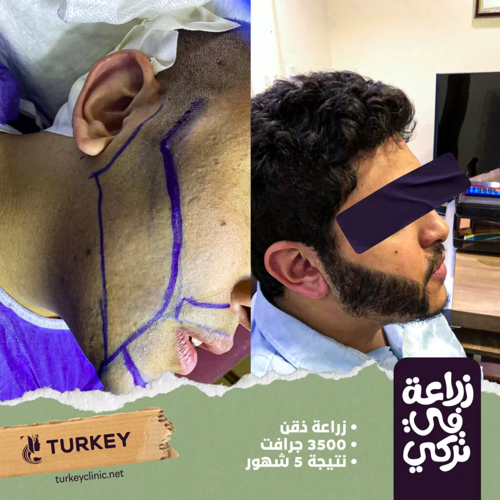 تجربتي في زراعة الذقن بالصور