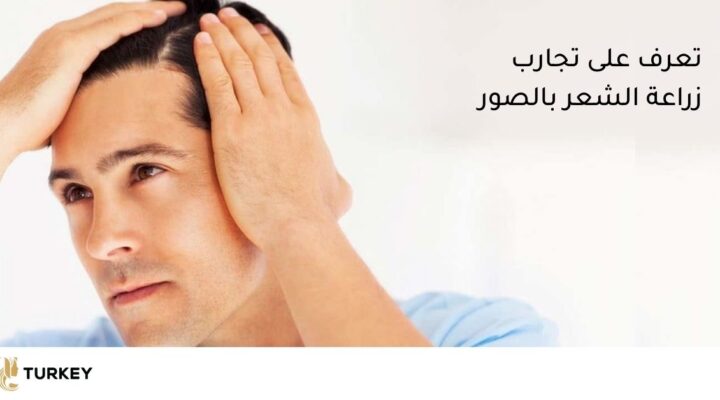 تعرف على تجارب زرع الشعر