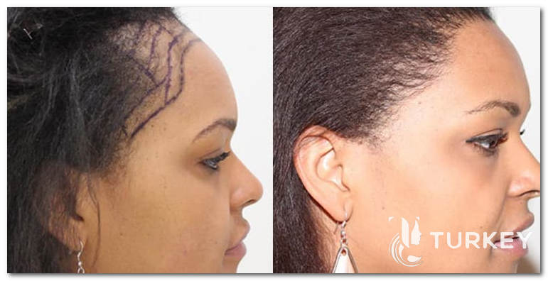 زرع الشعر الطويل للنساء