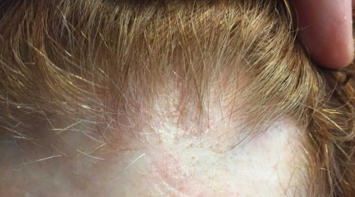 زراعة شعر الجبهة للنساء