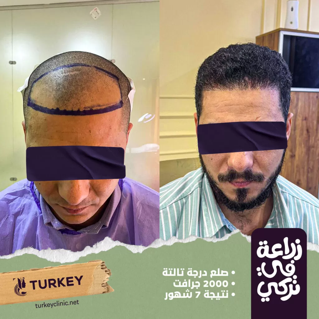 شكل شعر قبل وبعد الزراعة بالصور