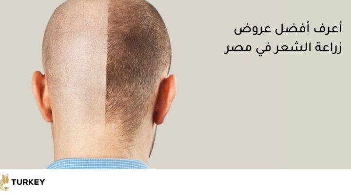 خصومات على عمليات زراعة الشعر