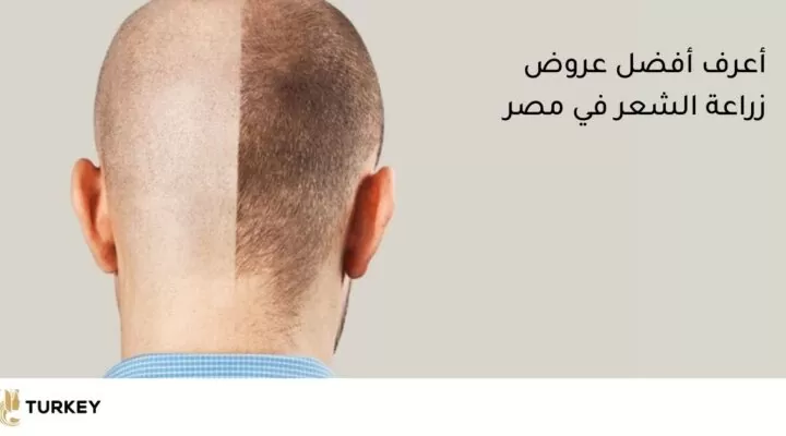 خصومات على عمليات زراعة الشعر